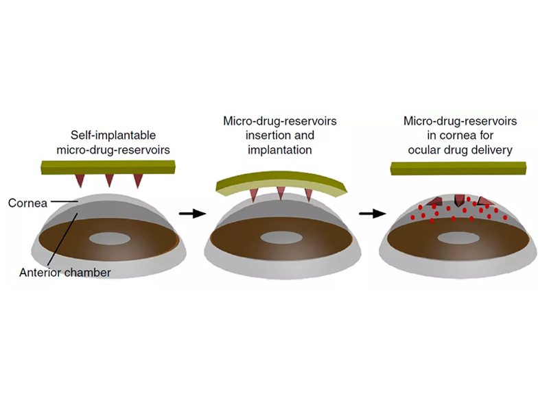 lentilles_de_contact_innovantes_micro_aiguilles